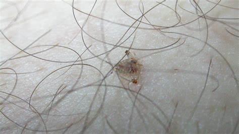 女子眼睛瘙痒难耐,医生从睫毛夹出17只阴虱