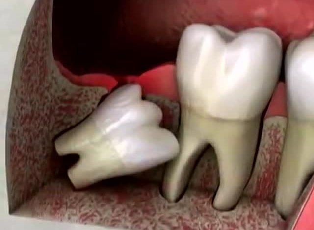 横着长的智齿有什么危害