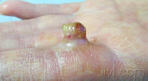 典型图片--化脓性肉芽肿