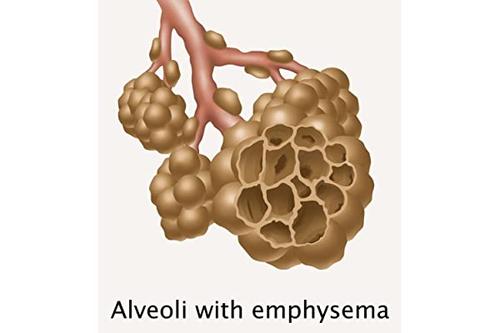 gwen shockeyscience source 出品的 alveoli with emema 海报印刷品