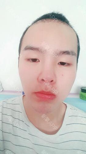 激光脱毛 | 术后当自强 | 国内整形 | 北京同城 | 男生整形 | 脱唇