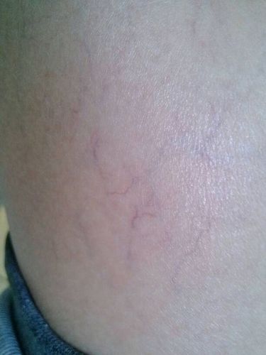 皮下毛细血管太明显,局部地方看上去很明显,发红发紫!