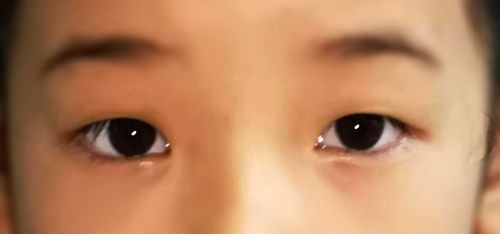 一分钟鉴别孩子斜视