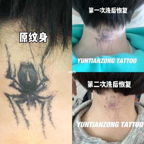 对比图纹身掉色确实明显,没有增生留疤96