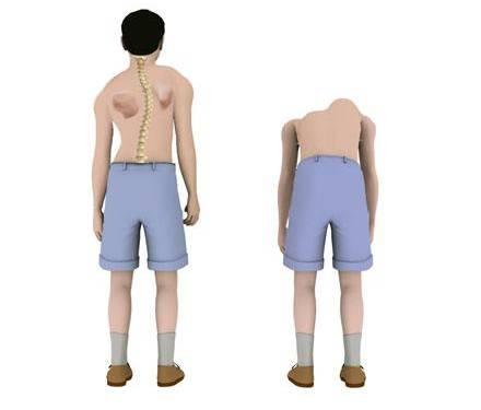 在胸椎的位置带旋转的椎体会推挤两旁的肋骨,造成胸骨架变形,局部胸腔