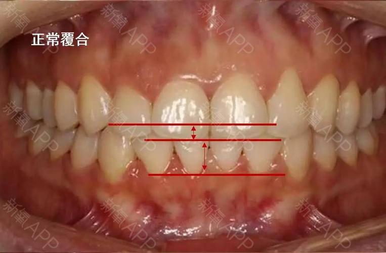 深覆合 正常的牙齿咬合,是上前牙盖过下前牙的距离不超过下前牙