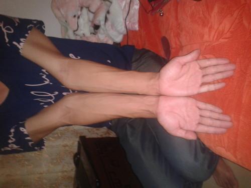 手肘明显凸出.这样可以当兵吗?有图,做等专家,急用