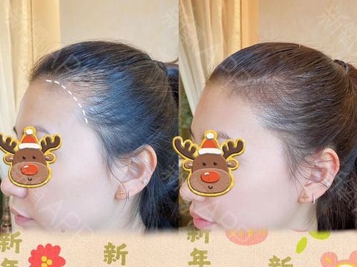 半永久纹发际线