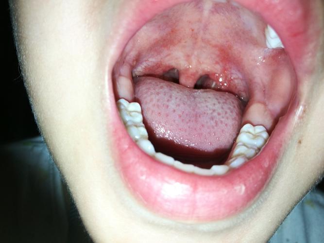 右边喉咙图片,有个白色的,请问各位是什么,知道吗?孩子咳嗽突