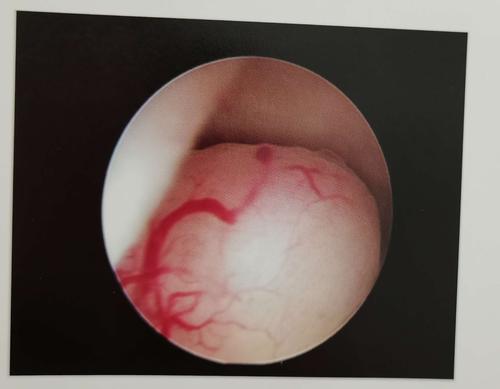 粘膜下子宫肌瘤