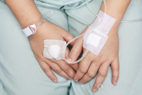 用生理盐水静脉注射(iv)肿胀的手.