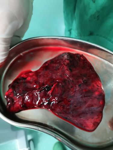 胸腔镜下右肺上叶切除术