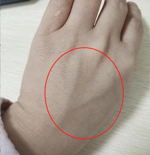 手上5个地方,如果有明显的"青筋",这提示血管可能有些情况了