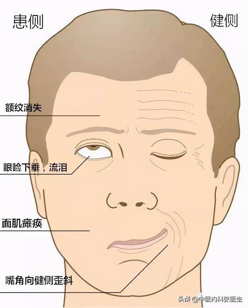 关于面瘫(面瘫还会有哪些表现?