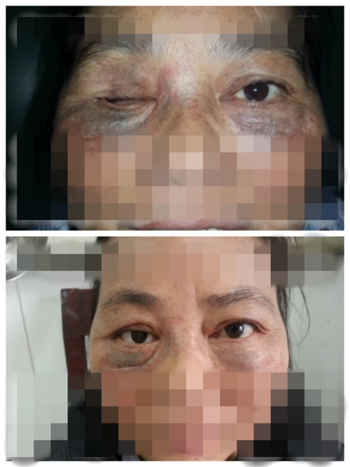 义眼台植入术前后对比图