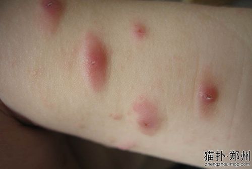 宝宝8个月,身上频繁出红色小疙瘩,去多家儿童医院诊断