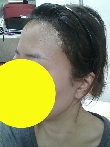 我在韩国做了发际线调整手术.现在为大家撰写下我的手术后记.