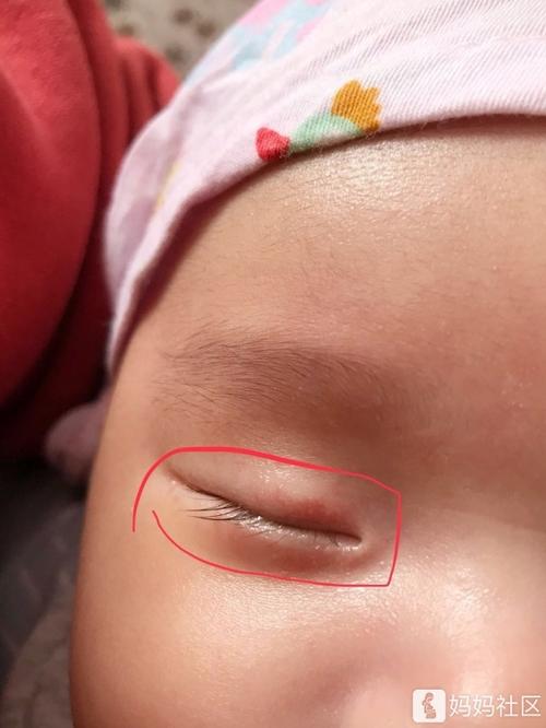 宝宝眼皮和眼角的红点白点怎么消除?