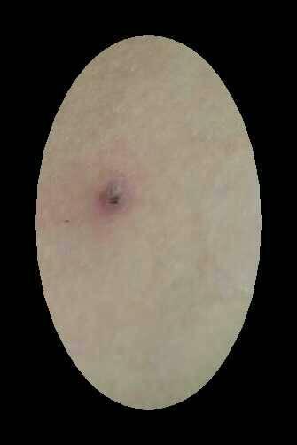   按默认排序|2条回答  2 分钟前 |五级 应该是种毒疮来的,建议