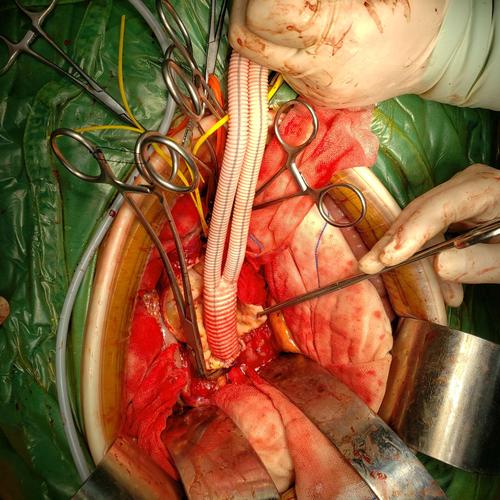 开刀腹主动脉瘤手术过程