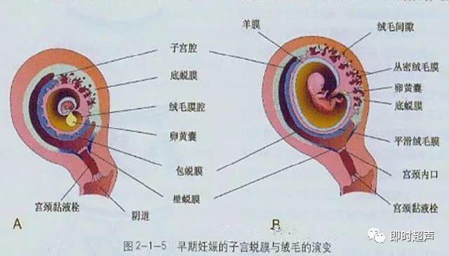 绒毛膜下血肿超声表现