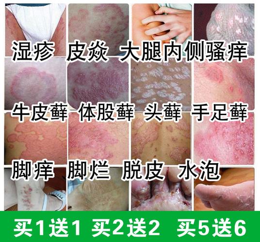 癣王成人阴囊湿毒红疹牛皮屁股痒脚痒大腿内侧痒止痒药膏