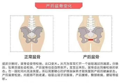 产后耻骨分离的危害产后耻骨分离的危害 骨盆变化:髋骨节移位,变形