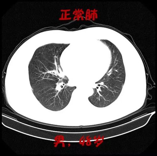 首先我们来看一下,肺部ct正常人的双肺!