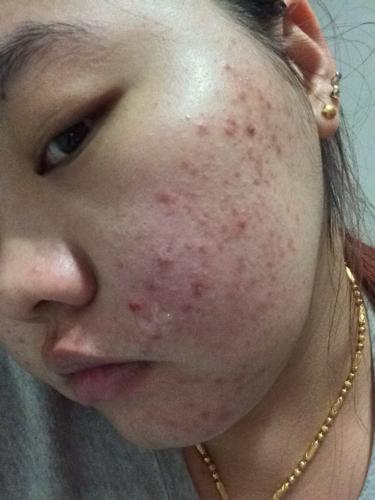 脸上涨了好多痘痘,去医院说是毛囊炎,吃了药也不管用