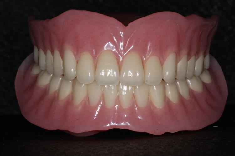 全口吸附性义齿