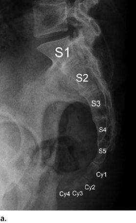 尾骨创伤及尾骨疼痛的影像学表现