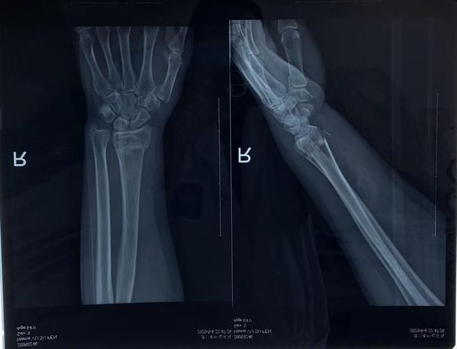 诊断:左桡骨远端陈旧性骨折 处理:手术治疗 case2 case3