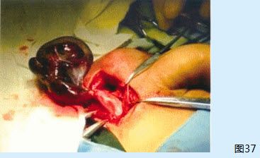 患者男性,20岁,左侧阴囊区肿胀伴疼痛3天,于当地医