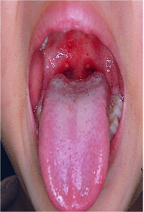 疱疹性咽峡炎就是手足口病吗?