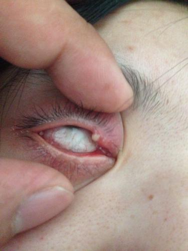 眼皮上长了个浓疙瘩,能用针挑开它,把浓放出来吗?