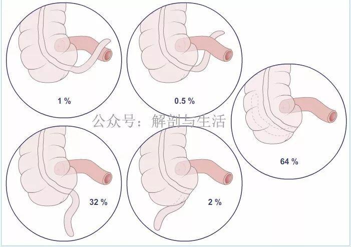 阑尾解剖