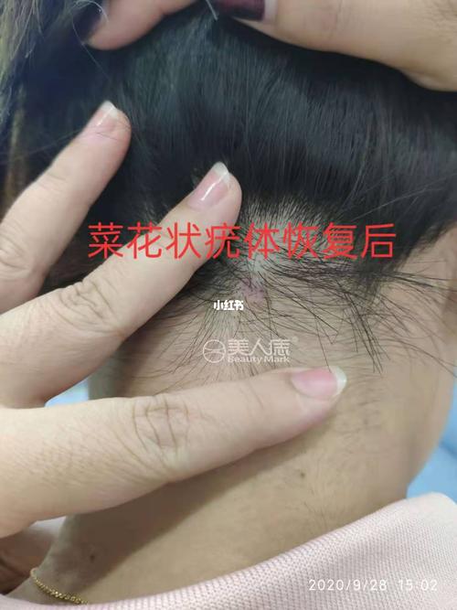 发中疣!菜花状的你见过吗?