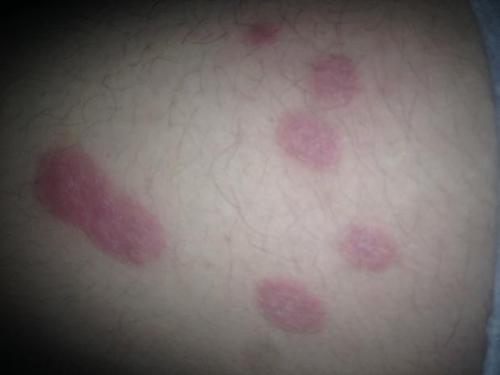 皮肤出现3种异常,很可能是癌细胞出现了,要预防癌症