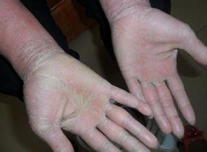 对称性进行性红斑角化症