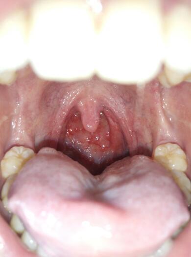 还有喉咙里面有肉疙瘩,好几个月了,这是怎么回事啊?