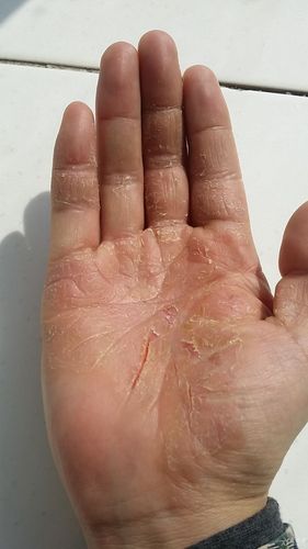 当归四逆汤内服,消风散外洗  过年后,又变严重了,右手掌浮肿,干裂