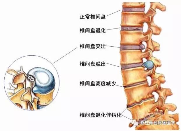 椎间孔镜技术治疗腰椎间盘突出有哪些优势?