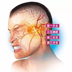 你以为牙坏了拔牙其实是三叉神经痛