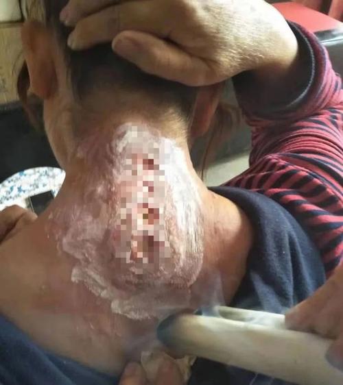 玉林这家无证诊所致患者皮肤溃烂!良心何在?