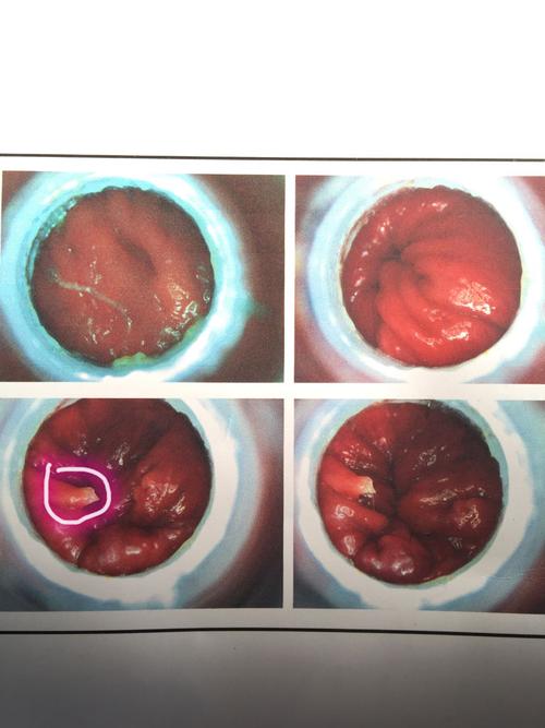 肛乳头还是息肉啊  还有我有几个痔核啊  属于几期 不便血 没有脱出物