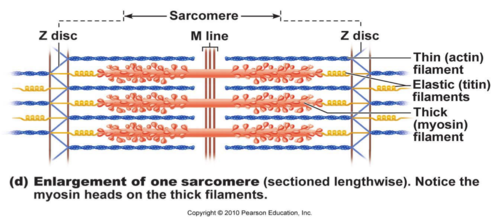 enlargement of one sarcomere