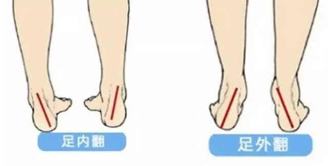 孩子严重足内翻不能等及早了解定制矫正鞋进行科学干预