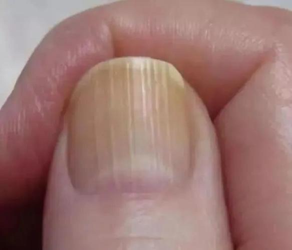 指甲上出现竖纹,警惕这4种疾病"找上门",提高警惕,莫