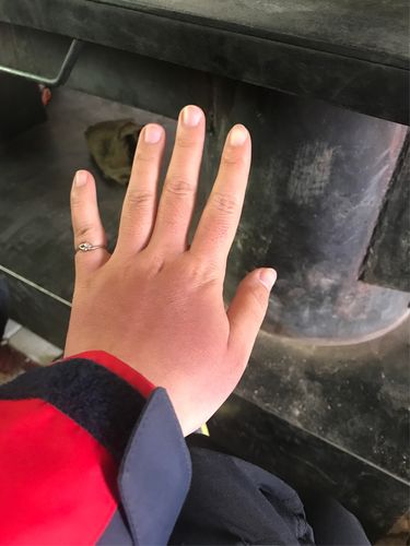 晒伤的手又冻伤啦