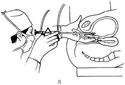 经尿道膀胱肿瘤电切术